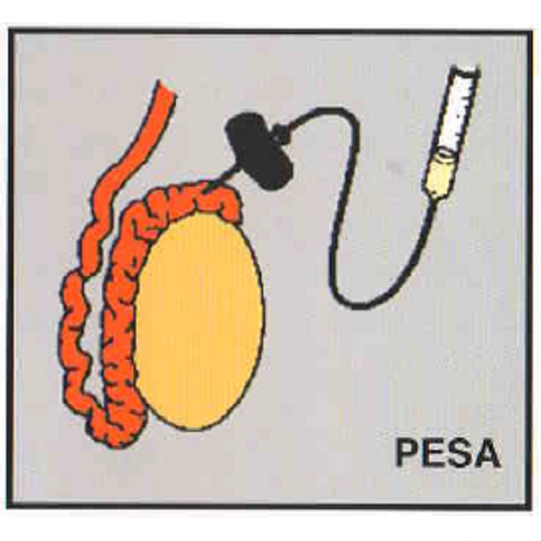 Epididymal sperm aspiration