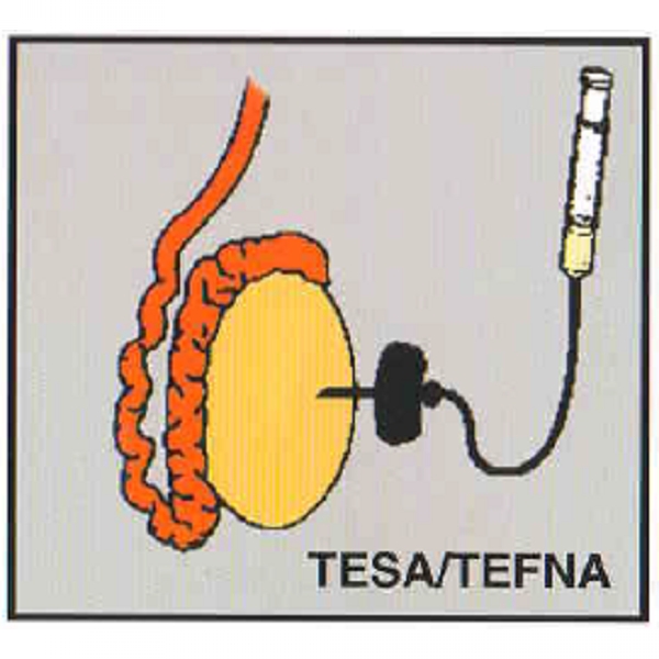 Epididymal sperm aspiration